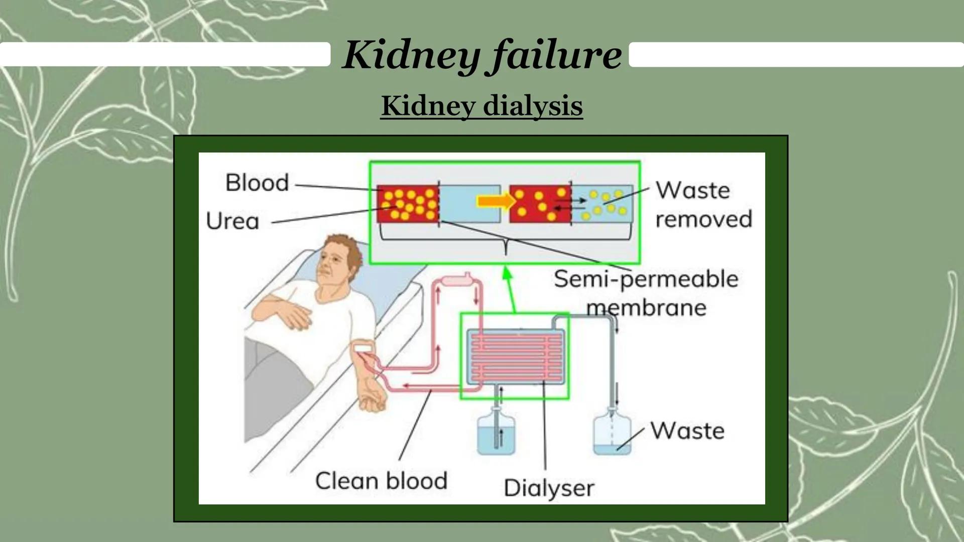 Blood
Urea
Kidney failure
Kidney dialysis
:: Waste
removed
Semi-permeable
membrane
Clean blood
Dialyser
Waste Kidney failure
Kidney failure